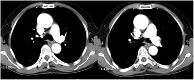 Case report: Efficacy of icotinib treatment in lung adenocarcinoma with esophageal squamous cell carcinoma: a rare case of double primary malignant tumors